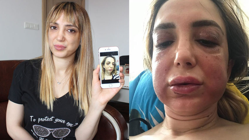 Yüzü tanınmaz hale geldi!.. İşte sebebi!