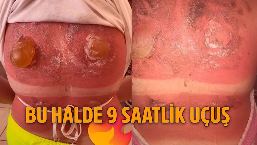 Dikkatsiz genç kız feci halde yandı
