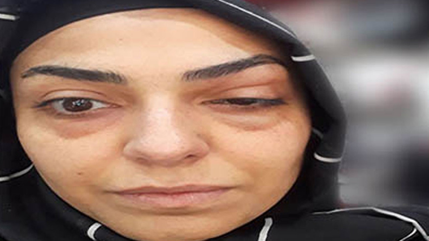 Botoks yaptırdı, bu hale geldi