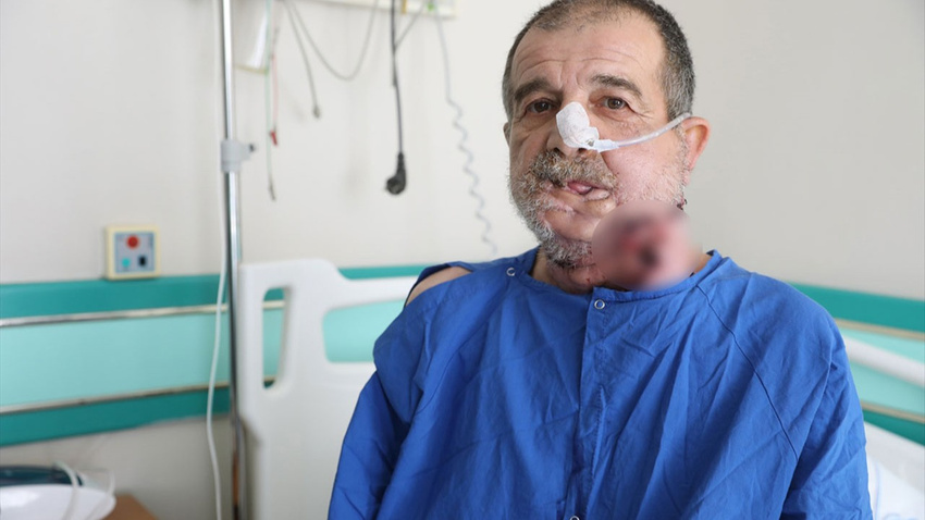 Bacak kemiğinden yeni çene yaptılar