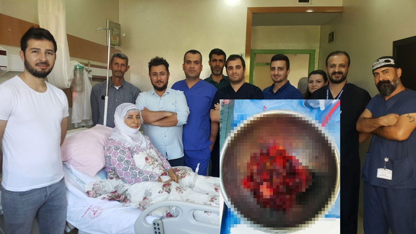 Kalbinden mandalina büyüklüğünde tümör çıkarıldı
