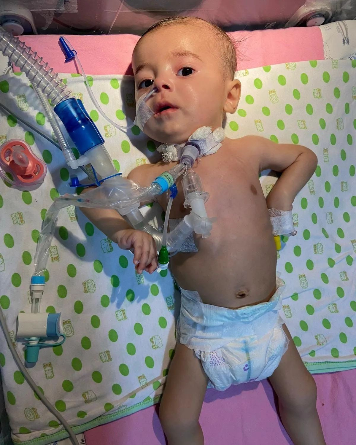 Adana�da yaşayan 5 aylık SMA tip 1 ölümcül kas hastası